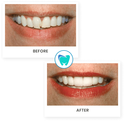 First Street Smiles-north Andover-Before and After