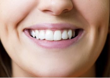white fillings in North Andover